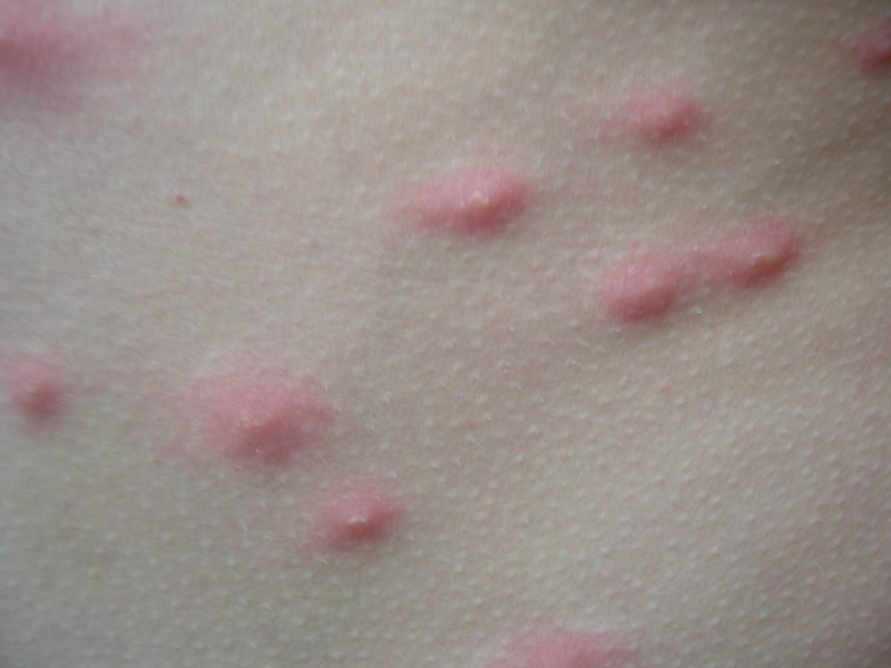 Аллергические заболевания кожи фото и названия - Фото болезней